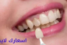 أسعار تلبيس الأسنان في السعودية