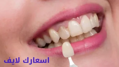 أسعار تلبيس الأسنان في السعودية