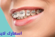 سعر تقويم الأسنان للفك العلوي