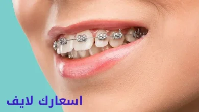 سعر تقويم الأسنان للفك العلوي