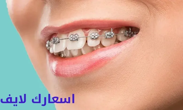 سعر تقويم الأسنان للفك العلوي