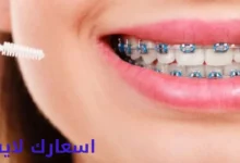 اسعار تركيب تقويم الاسنان في مصر