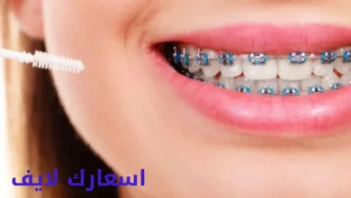 اسعار تركيب تقويم الاسنان في مصر