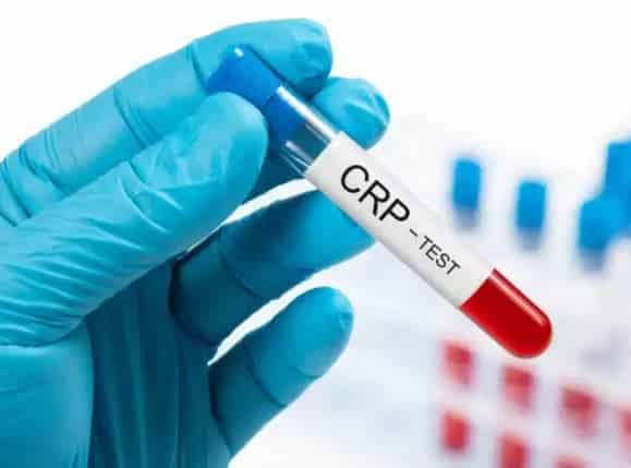 سعر تحليلCRP في معامل مصر 2025