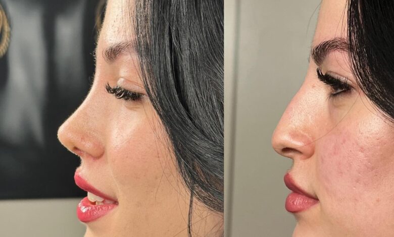 أسعار عمليات تجميل الأنف 2025