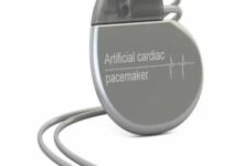 سعر جهاز ICD لتنظيم ضربات القلب في مصر 2025